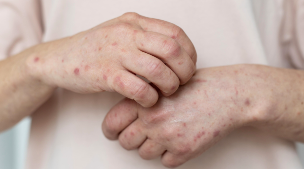 Colombia suma cinco casos de sarampión importado en 2026